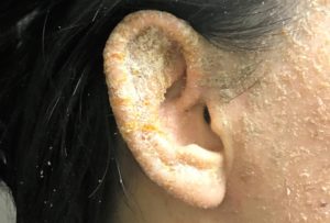 耳の湿疹　右